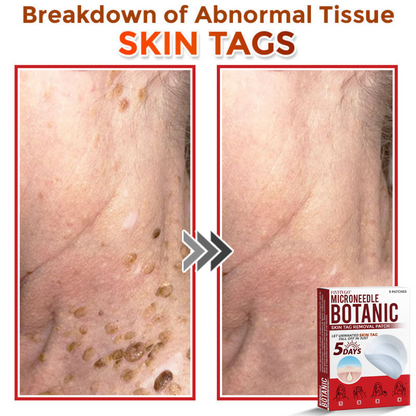 VanaSculpt®  Botanical MicroNeedle Skin Tag Therapy Patch