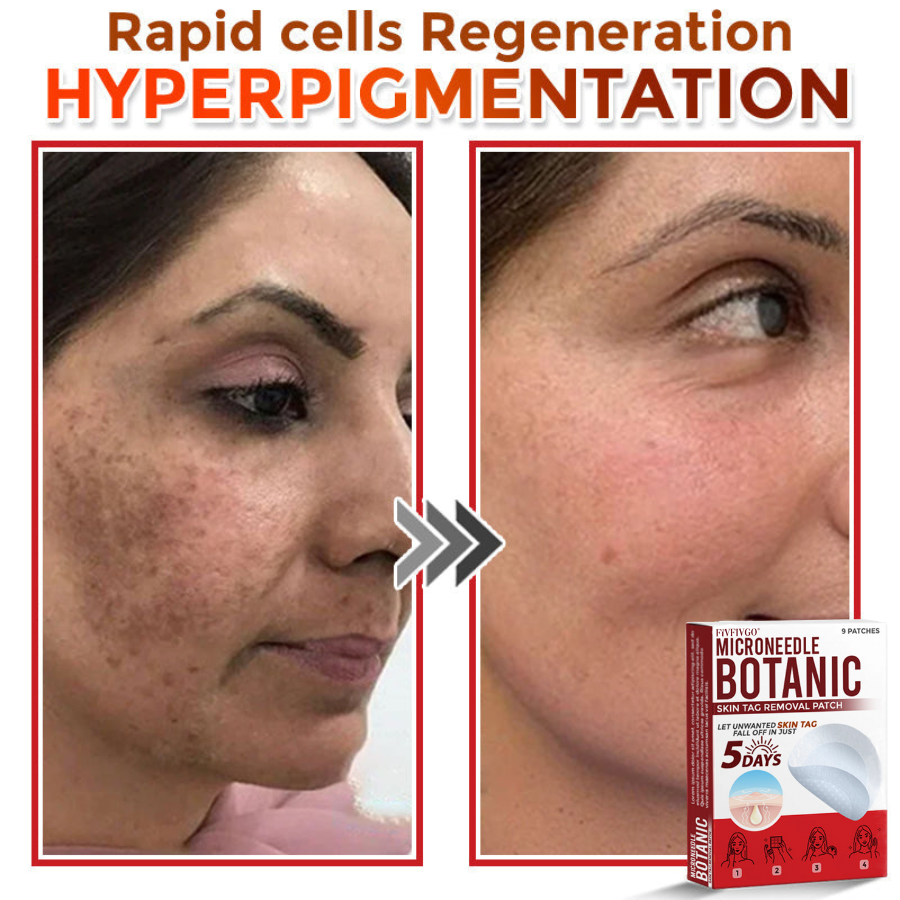 VanaSculpt®  Botanical MicroNeedle Skin Tag Therapy Patch