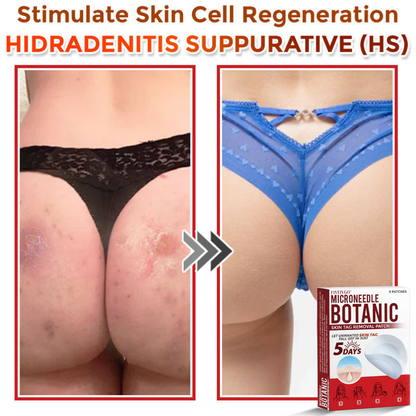 VanaSculpt®  Botanical MicroNeedle Skin Tag Therapy Patch