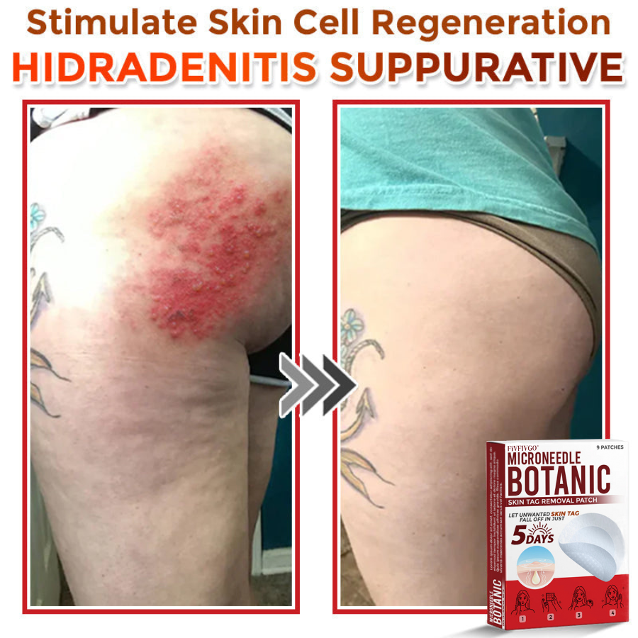 VanaSculpt®  Botanical MicroNeedle Skin Tag Therapy Patch