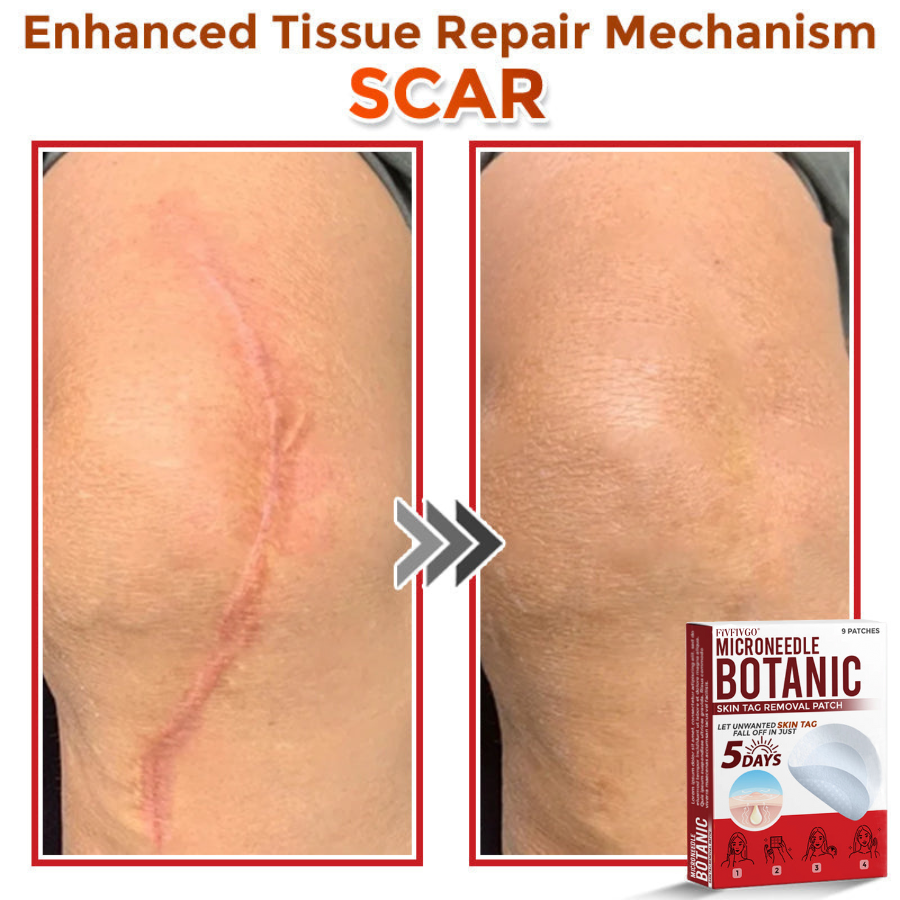 VanaSculpt®  Botanical MicroNeedle Skin Tag Therapy Patch