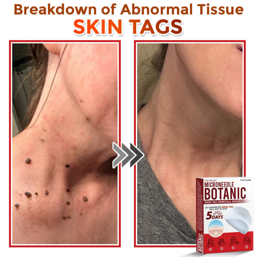 VanaSculpt®  Botanical MicroNeedle Skin Tag Therapy Patch