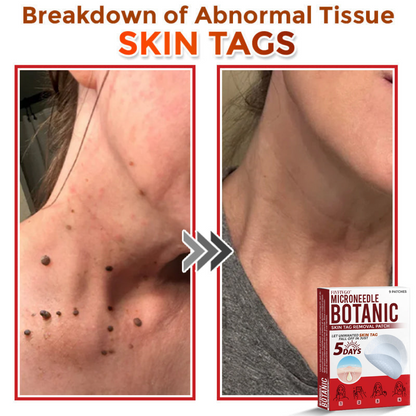 VanaSculpt®  Botanical MicroNeedle Skin Tag Therapy Patch