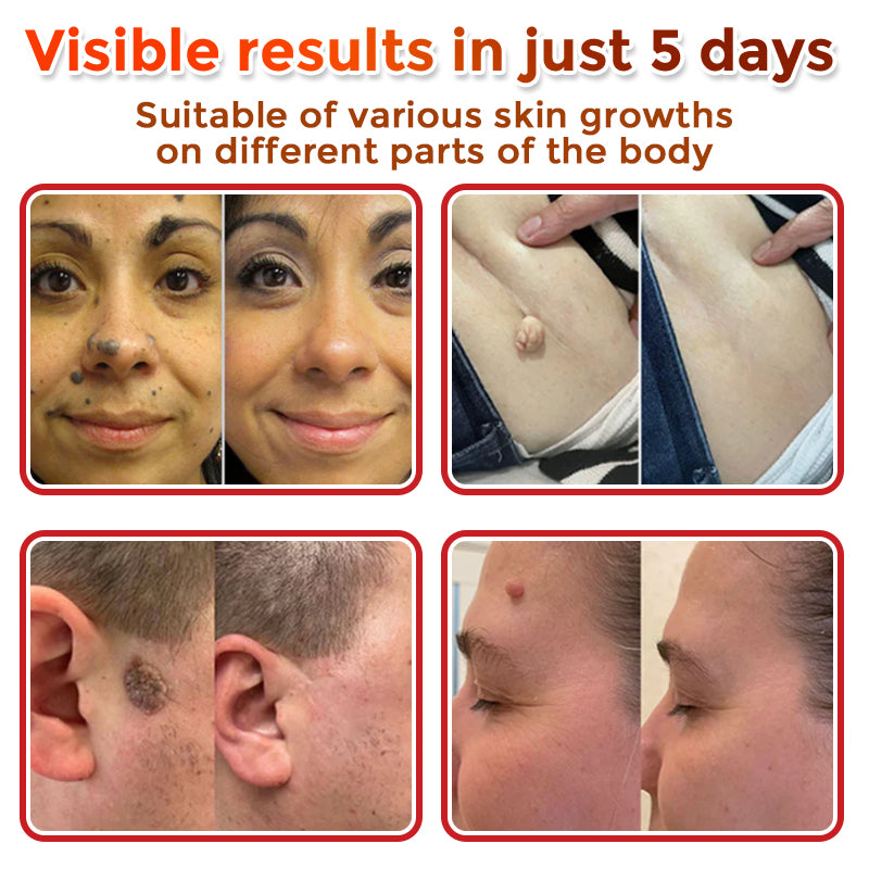 VanaSculpt®  Botanical MicroNeedle Skin Tag Therapy Patch